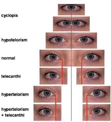 Upslanting Palpebral Fissure