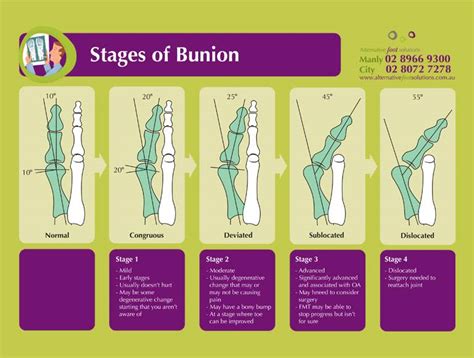 Bunions Sydney | Causes & Symptoms | Manly Vale & Northern Beaches