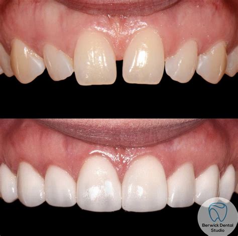 Gap Between Teeth - Berwick Dental Studio | Dentist Berwick ...