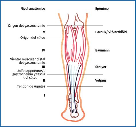 Alargamiento Proximal Del Gastrocnemio Medial En El Tratamiento De La