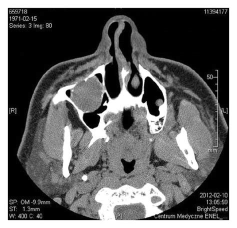 Ct Cm Diameter Oval Hypodense Tumor In Right Maxillary Sinus