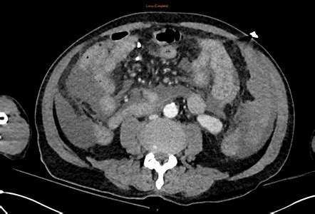 Spontaneous Splenic Rupture Radiology Case Radiopaedia Org