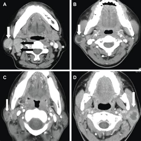 The Multiple Tuberculous Lesions Of Right Parotid Nodes Are Linearly