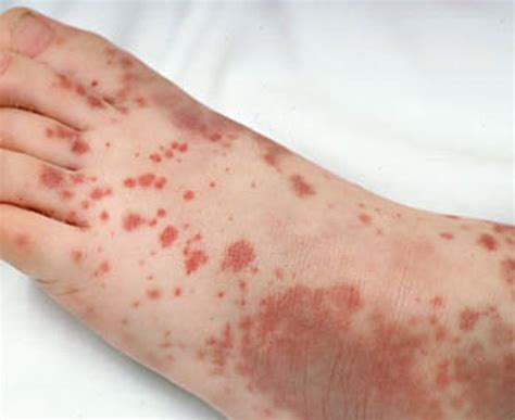 👉 Purpura - Pictures, Causes, Symptoms and Treatment (November 2021)