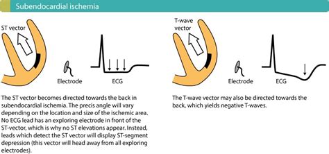 Evaluation of exercise stress test: ECG, symptoms, blood pressure, heart rate, performance – ECG ...