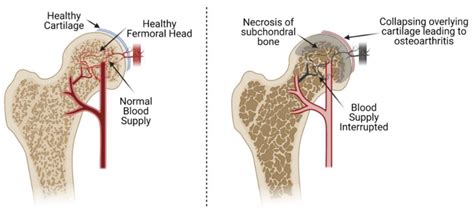 Understanding Avascular Necrosis Ask The Nurse Expert