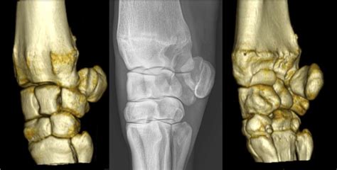 Carpus Bone Anatomy - DLPMO Diagram | Quizlet