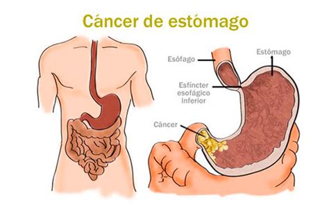 Cáncer De Estómago Enfermedades Wiki Fandom