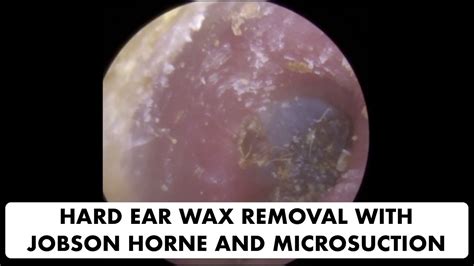 Hard Ear Wax Removal With Jobson Horne And Microsuction Ep 20 Youtube