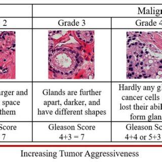 Gleason Scores And Prostate Cancer Grading System The Gleason Score