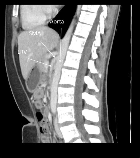 Nutcracker Syndrome Ultrasound