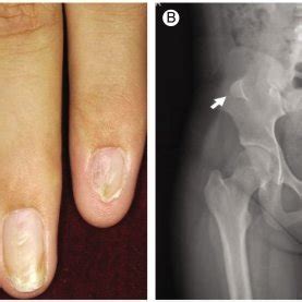 Summary Of Clinical Features Of Patients With Nail Patella Syndrome