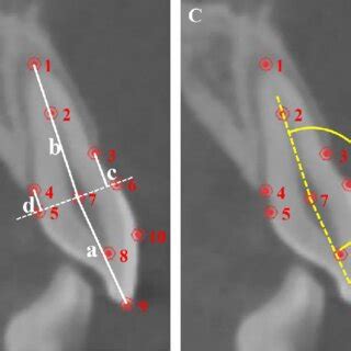 Measurement Of Dental Anatomic Characteristics A Point Identification