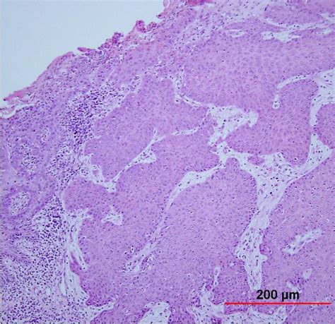 Carcinoma Squamous Cell Carcinoma Of Cervix