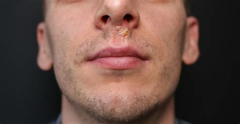 Virus Del Herpes Debajo De La Nariz Herpes Labial Despu S De La Gripe