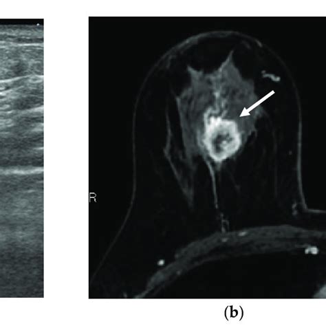 A Woman In Her 60s Was Found To Have A Right Invasive Ductal Carcinoma