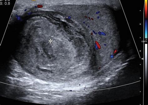 Testicular Seminoma And Its Mimics From The Radiologic Pathology