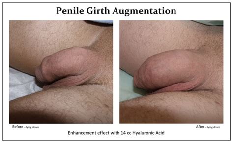 Penis Enlargement Penile Augmentation Increase Penis Size Penile