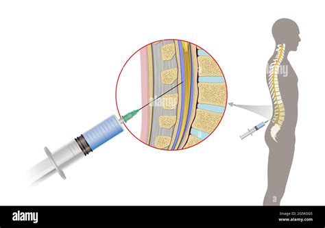 Lumbar Puncture Needle Hi Res Stock Photography And Images Alamy