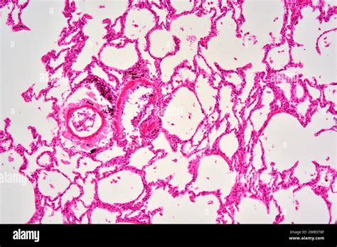 Human Lung Section Showing Alveoli Bronchiole And Blood Vessels X75