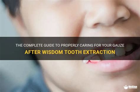 The Complete Guide To Properly Caring For Your Gauze After Wisdom Tooth Extraction Medshun