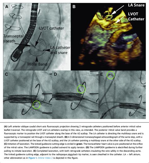 Lampoon To Enable Transcatheter Mitral Valve Replacement Inside A