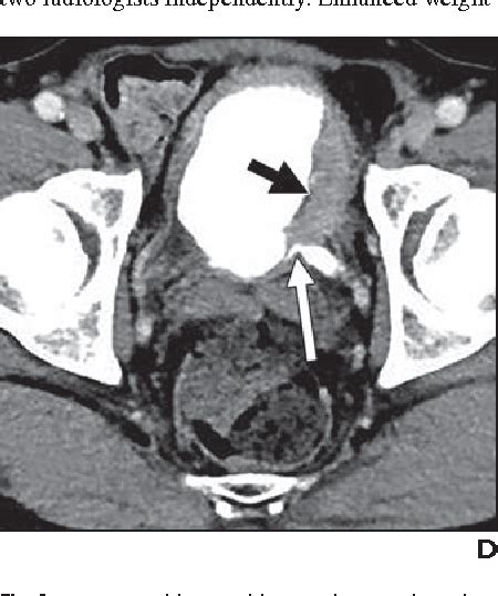 Figure 1 From Split Bolus Portal Venous Phase Dual Energy CT Urography