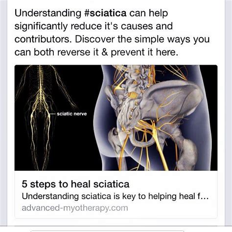 1000+ images about Sciatica / Hip pain / Pain on Pinterest | Knee pain ...