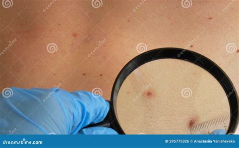 Mole Dermoscopy Preventive Of Melanoma Dermatologist Examining