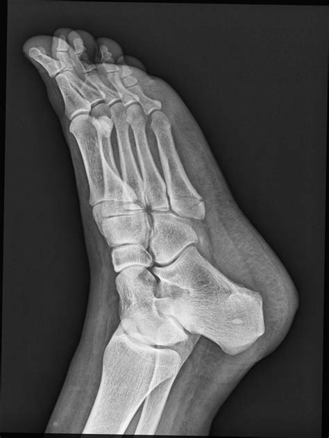 Jones And Pseudo Jones Fractures Image