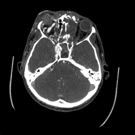 Caroticocavernous Fistula Radiology Reference Article Radiopaedia