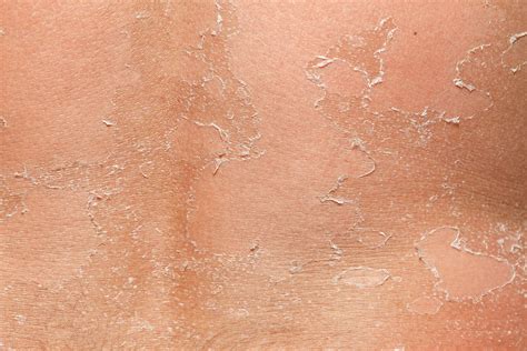 Skin Peeling: What Your Peeling Skin Wants to Tell You | The Healthy