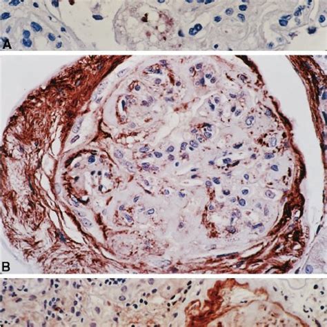 Diabetic Glomerulosclerosis A Mild Diabetic Glomerulosclerosis