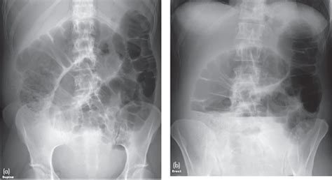 Pathophysiology Of Bowel Obstruction Flashcards Quizlet