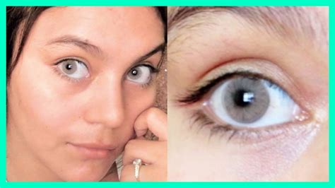 Ojos Blancos En Personas Percaylahmapa