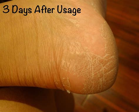 Purederm Exfoliating Foot Mask Review The Beauty Junkee