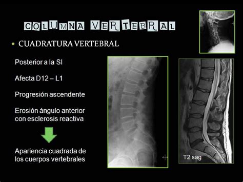 Figure 7 from Revisión de los hallazgos radiológicos en la espondilitis