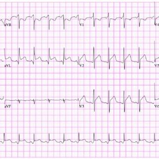 Electrocardiography The Initial Electrocardiogram Revealed Sinus