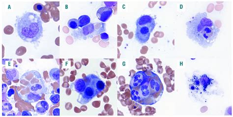 Bone Marrow Histomorphological Criteria Can Accurately Diagnose