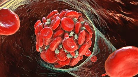 Blood Clot Made Of Red Blood Cells Platelets And Fibrin Protein