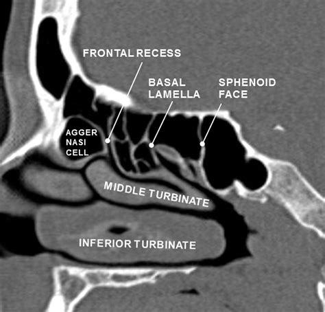 Frontal Sinus Ct Scan