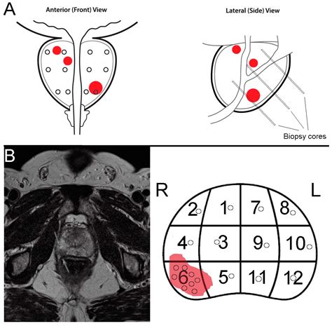 Cancers Free Full Text Mri Guided Targeted And Systematic Prostate Biopsies As Prognostic