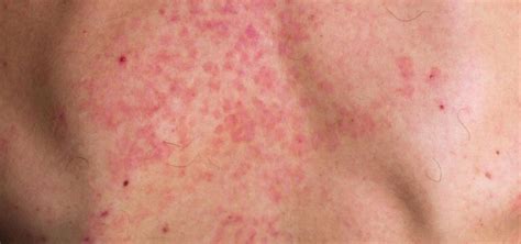 Tinea Versicolor Causes Symptoms And Treatment Dr Piotr Turkowski