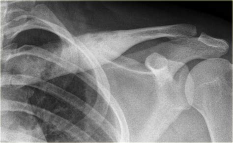 The Radiology Assistant : Sclerotic bone tumors