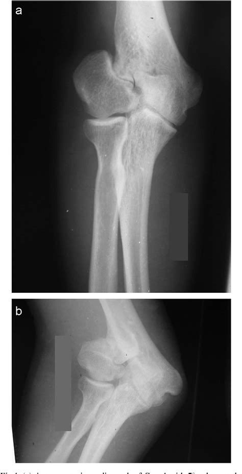 Table From Severe Tardy Ulnar Nerve Palsy Caused By Traumatic Cubitus