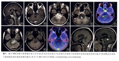 什么是脑干脑桥肿瘤？诊断、类型、治疗策略和新疗法解读儿童肿瘤治疗胶质瘤脑干 健康界