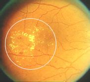 How to diagnose and manage diabetic retinopathy - EyeGuru