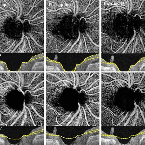 Representative Swept Source Optical Coherence Tomography Angiography