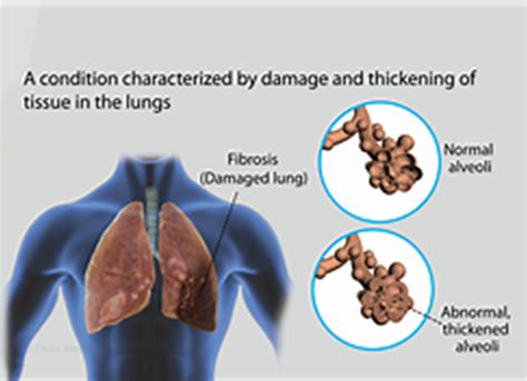 Pulmonary Fibrosis Saint Michaels Medical Center