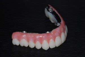 All on 4 Denture Implant Prosthesis Material - North Texas Dental Surgery